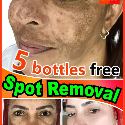 Advertisement for spot removal product showing a woman's face with dark spots and promotional text.