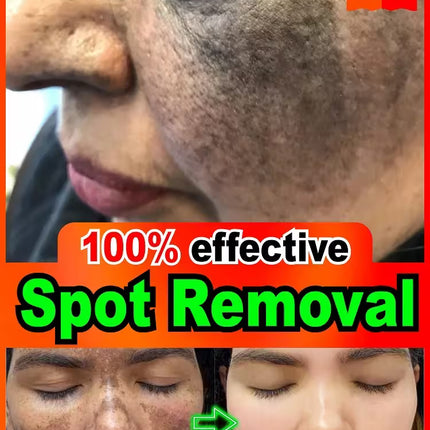 Before and after spot removal advertisement with a woman's face showing dark spots.
