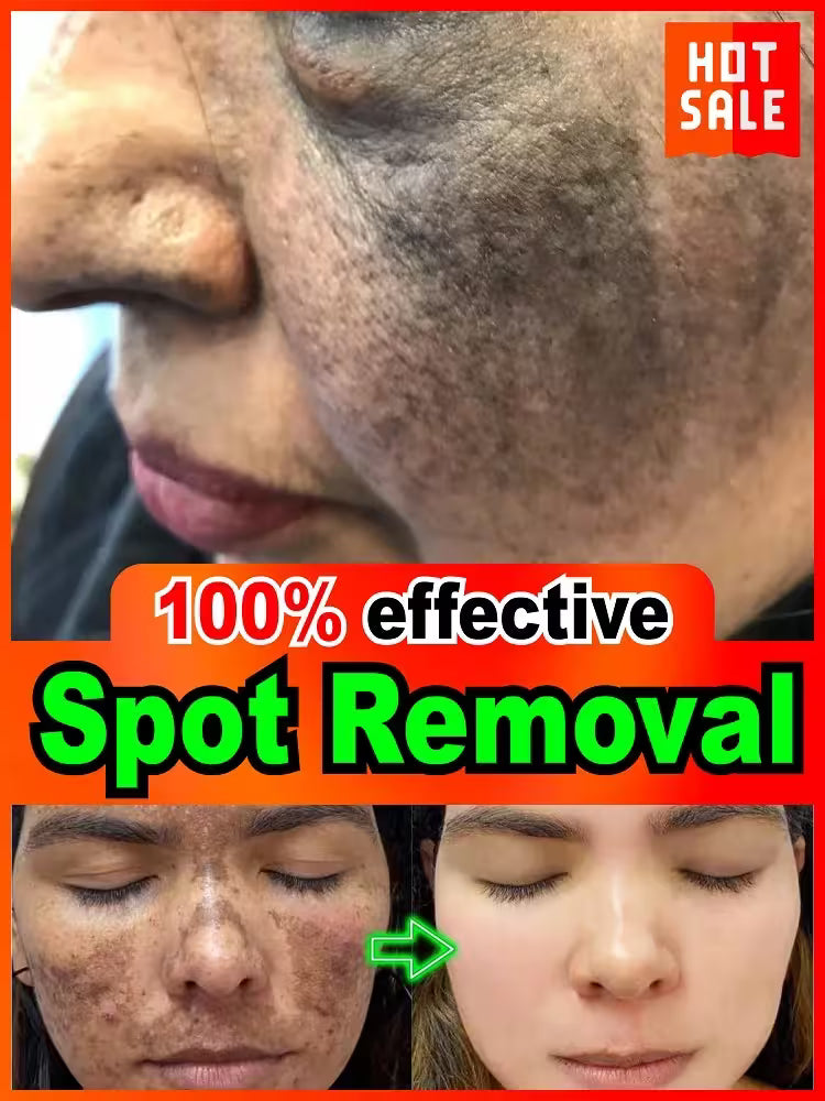 Before and after spot removal advertisement with a woman's face showing dark spots.